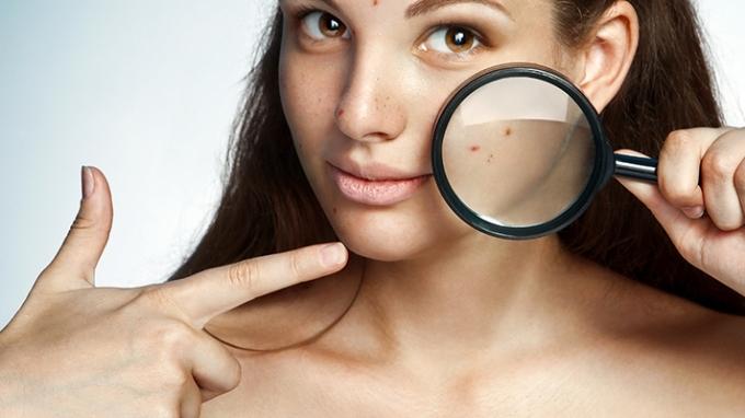 acne-during-pregnancy
