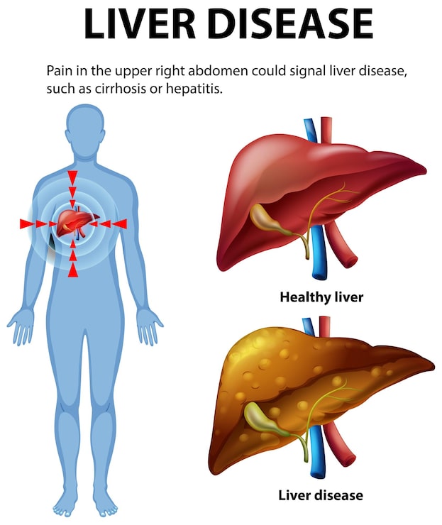 Understanding Liver Disease and Symptoms