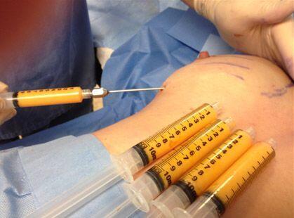 Breast Augmentation in Mumbai Breast Augmentation in Mumbai