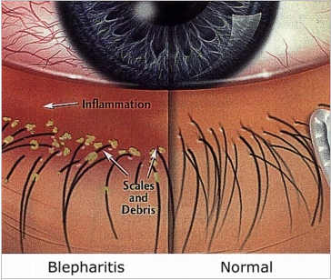 scaly blepharitis