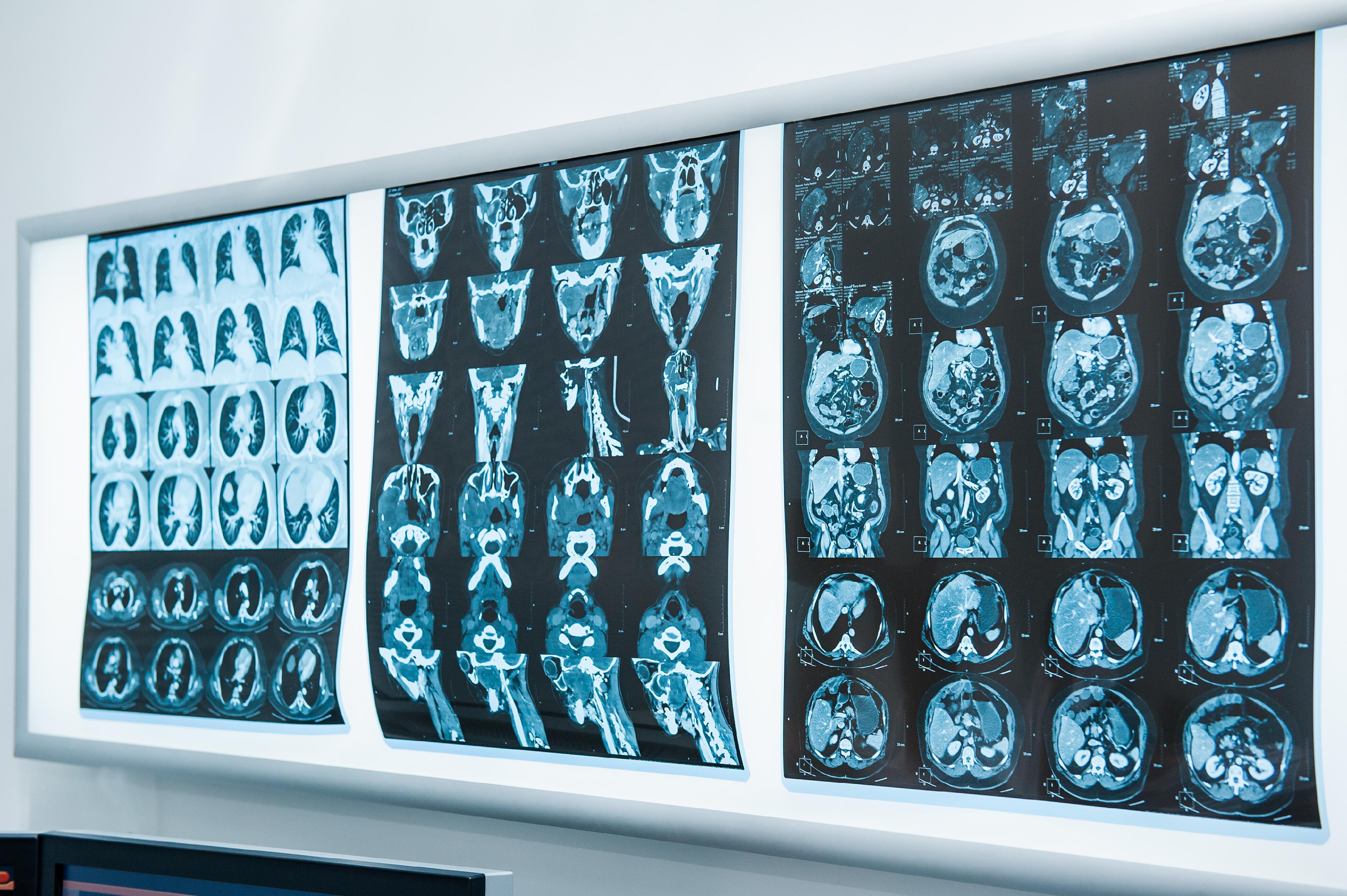 Encefalitis: MedlinePlus en español