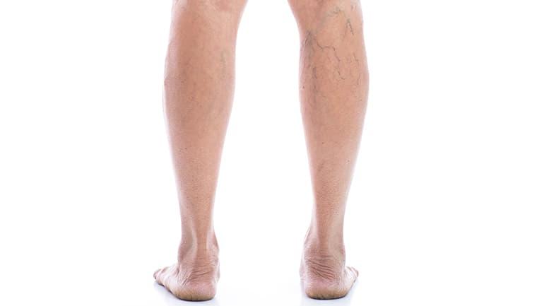 What-causes-spider-veins-Spider-and-Varicose-Vein-Treatment-Clinic.jpg