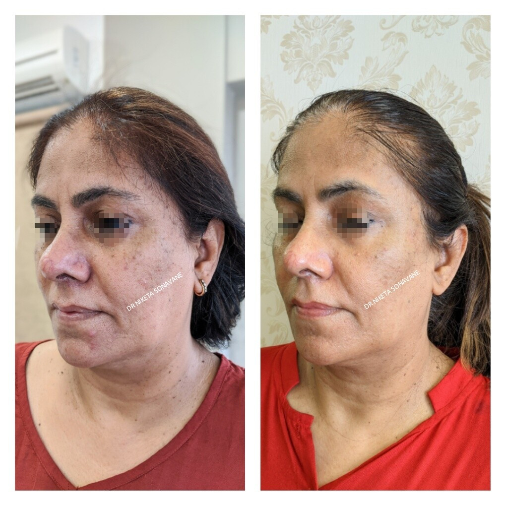 Anti Aging Treatment in Mumbai