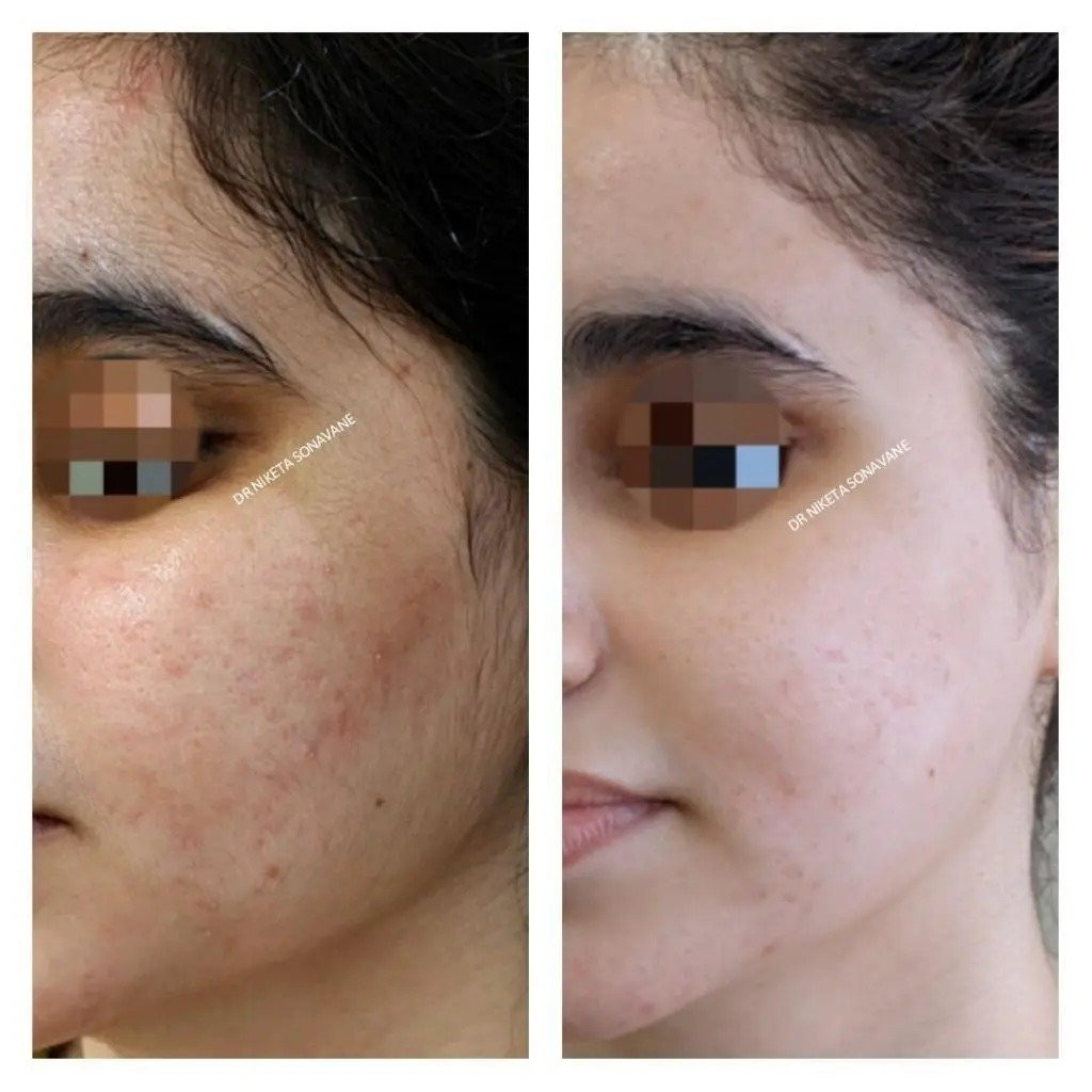 hyperpigmentation treatment in mumbai
