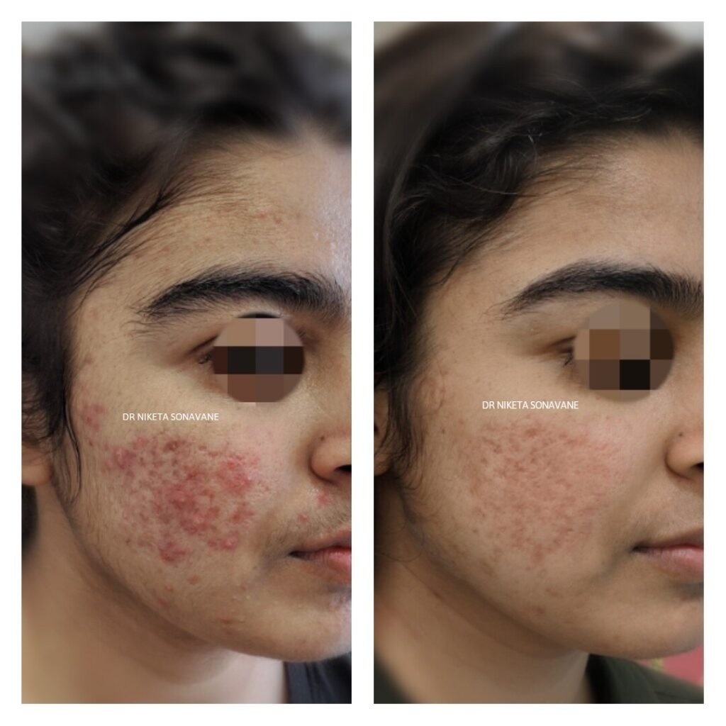 Acne Treatment in Mumbai
