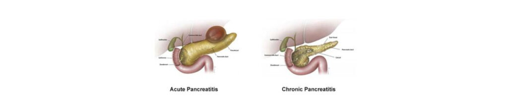 Best Pancreatitis doctor in Mumbai