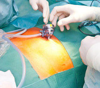 minimallyinvasivespinesurgery.jpg