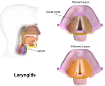 laryngitistreatmentinmumbai.png
