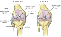 acltreatment.png