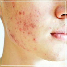 acne.jpg