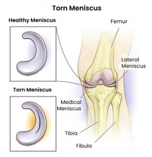 tornmeniscus.jpg