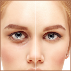 eyelidblepharoplasty.png