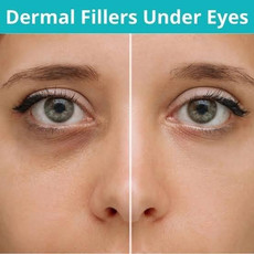 dermalfillerundereyeviva.jpg