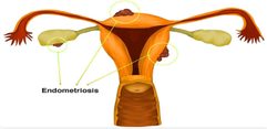 endometriosis.png