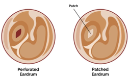 tympanoplastysurgery.png