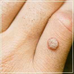 warts.jpg