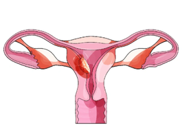 uterinecancersurgery.png
