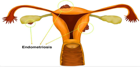 endometriosistreatment.png