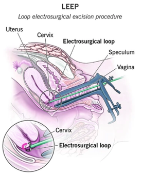 cervicalprecancertreatment.png