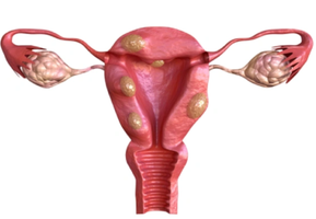 fibroid.png