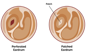 tympanoplastysurgery.png