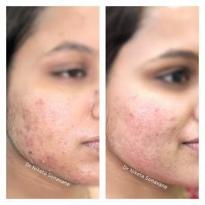 Acne Treatment in Mumbai: Dr. Niketa Sonavane
