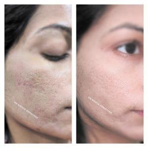Prp Treatment in mumbai