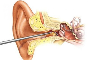 earwax.jpg