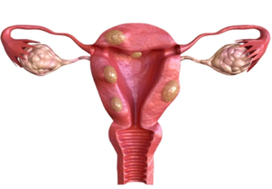 fibroid.png