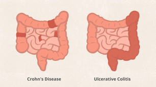 ulcerativecolitis_crohnsdisease.jpg