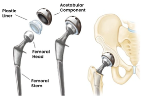 hipreplacement.png