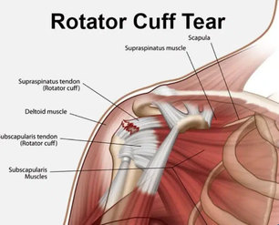 rotatorcufftear.png