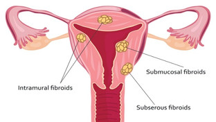 fibroidsremoval.jpg