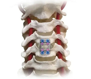 laminoplasty.jpg