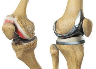 kneereplacementsurgery.png