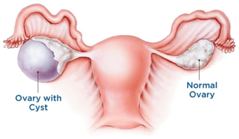 ovariancyst.png