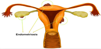 endometriosistreatment.png