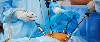 Laparoscopy for Infertility - Procedure ...