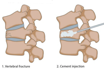 vertebroplastysurgeryinmumbai.png