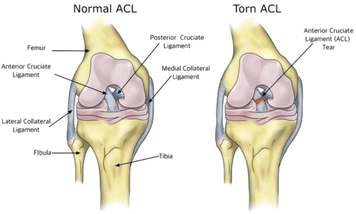 acltreatment.png