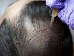 Hair Loss Treatment in Mumbai
