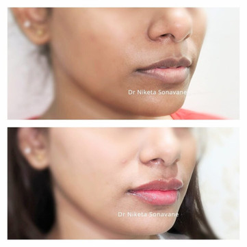 skin whitening treatment in mumbai