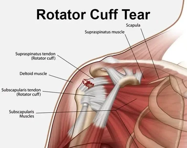 Inside the OT: Reporting on Arthroscopic Rotator Cuff Repair in Bangalore Doctor Near Me Arthroscopic Rotator Cuff Repair in Bangalore