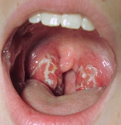tonsillitis treatment in mumbai