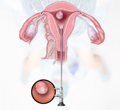 hysteroscopy surgery in thane