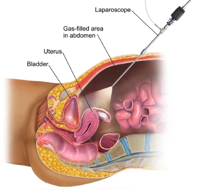 Laparoscopic Hysterectomy in Mumbai