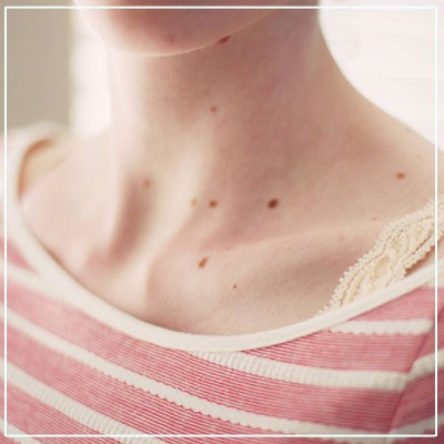 Mole Removal Treatment in Mumbai: Dr. Deepam Shah