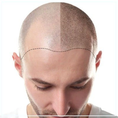 Scalp Micropigmentation in mumbai