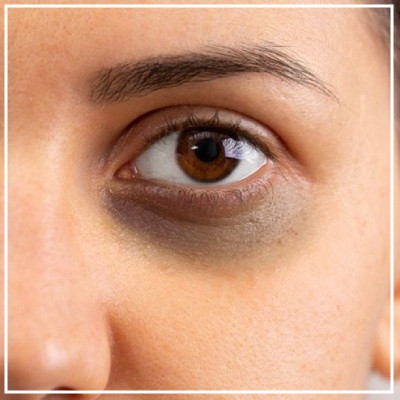 Dark Circles Treatment in Mumbai – Dr. Deepam Shah