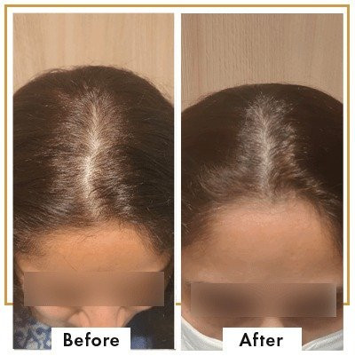 Female Hair Transplant in Mumbai